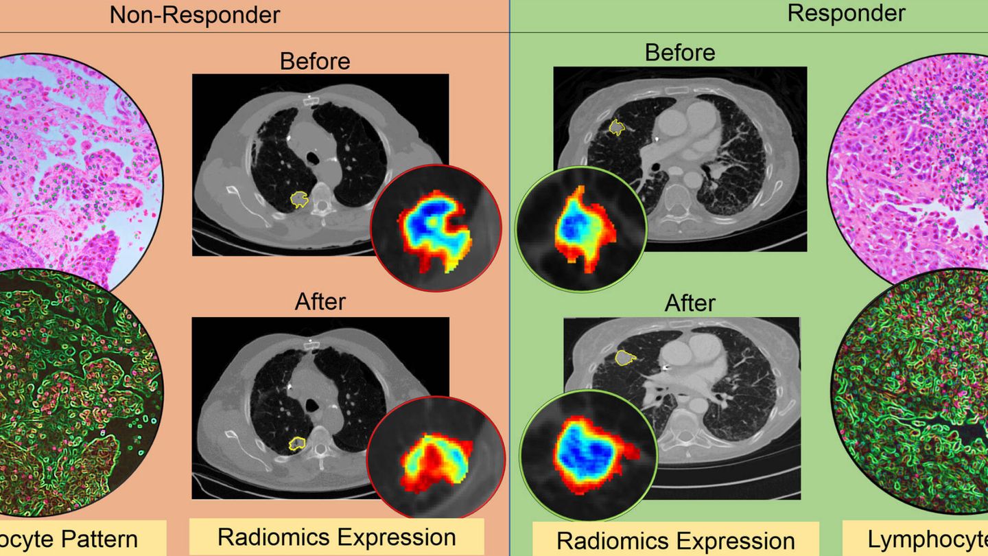 Densidad del tumor antes y después de inmunoterapia. Foto: Western Reserve University 