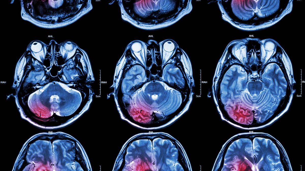 Análisis de sangre e inteligencia artificial: la nueva técnica contra los tumores cerebrales