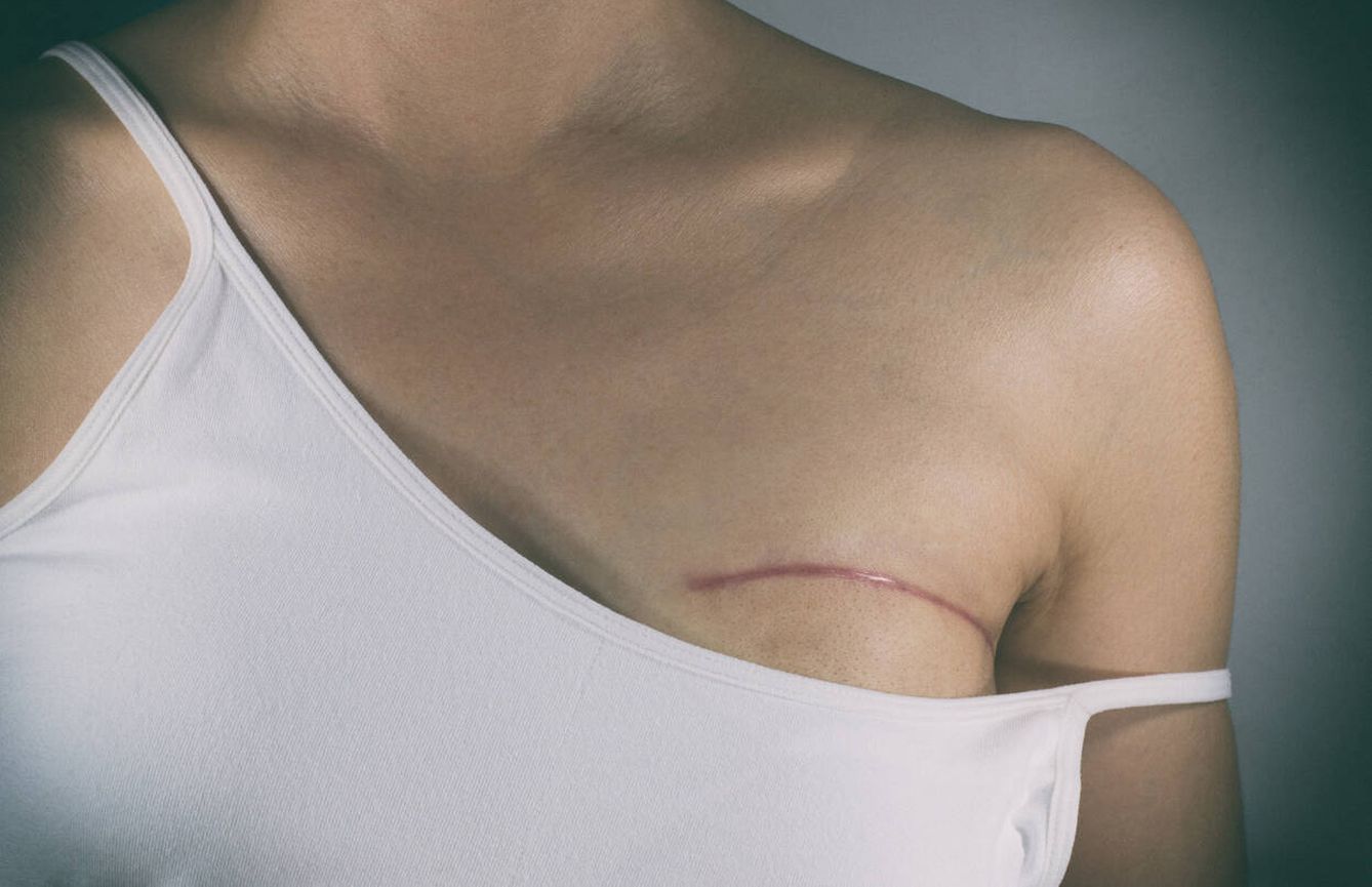 Las mastectomías han avanzado una barbaridad en 200 años. (iStock)