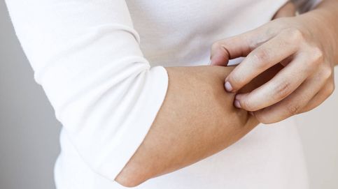 Dermatitis: cuando sufrir picores es una constante de vida