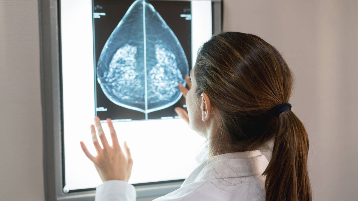 La nueva forma para prevenir la 'bomba de relojería' del cáncer de mama