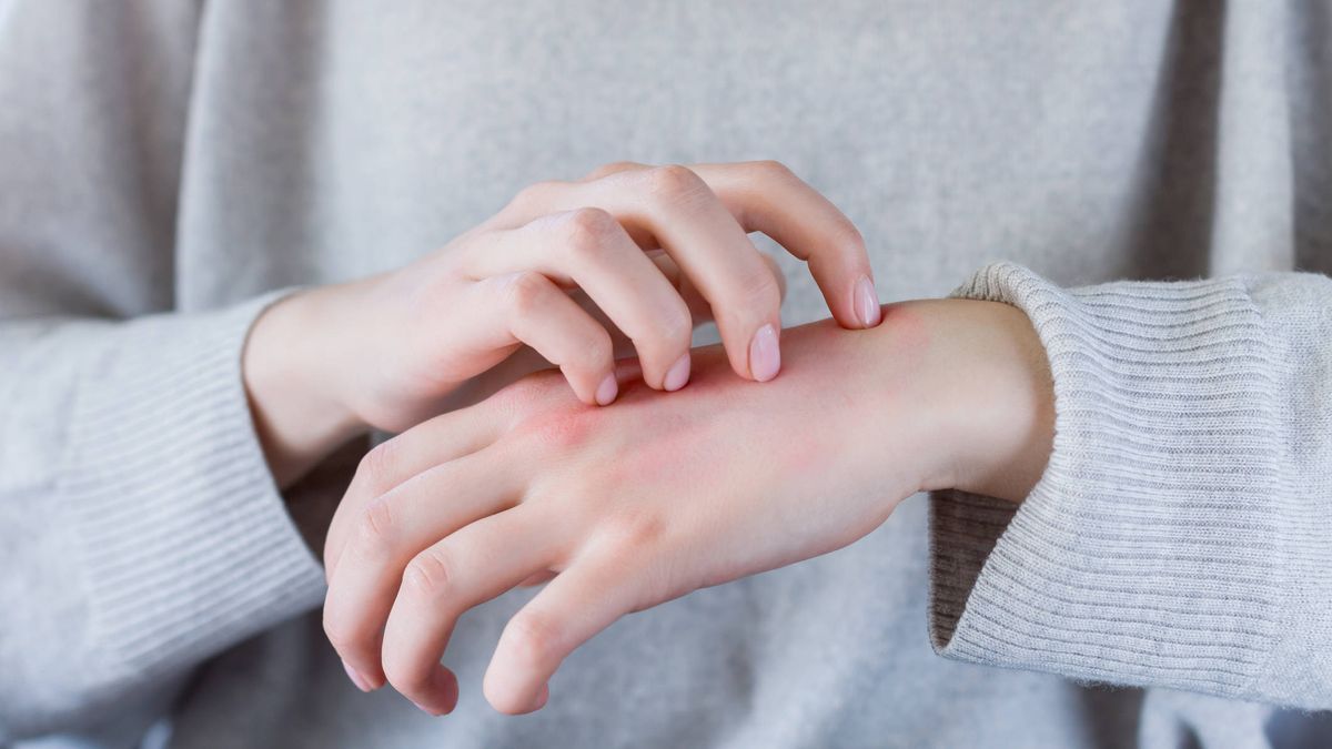 ¿Sufres un eczema? Esto es lo que le pasa realmente a tu piel