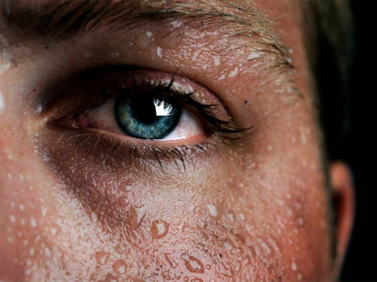 Foto: Alergia al sudor: por qué se produce, síntomas y tratamiento. (iStock)