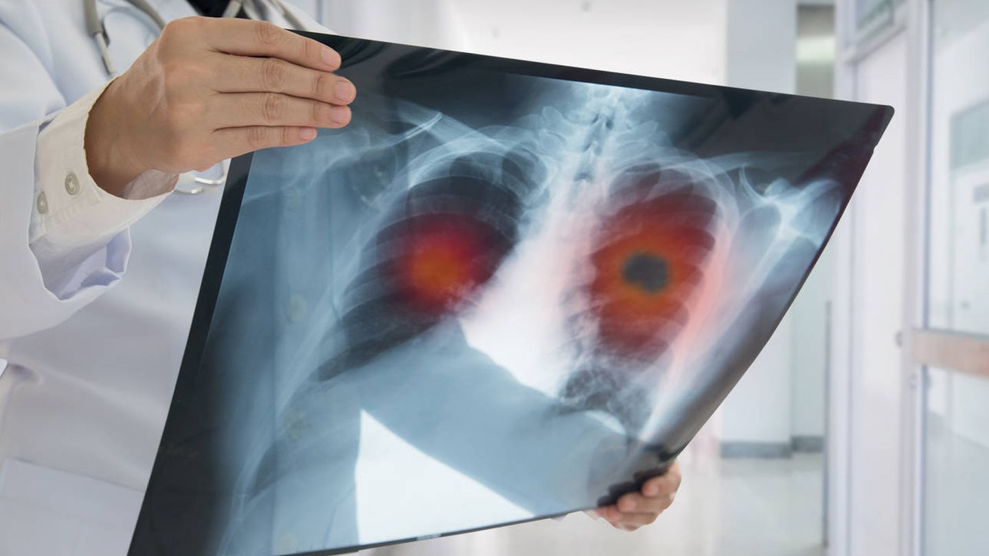 Una radiografía muestra un cáncer de pulmón. (iStock)