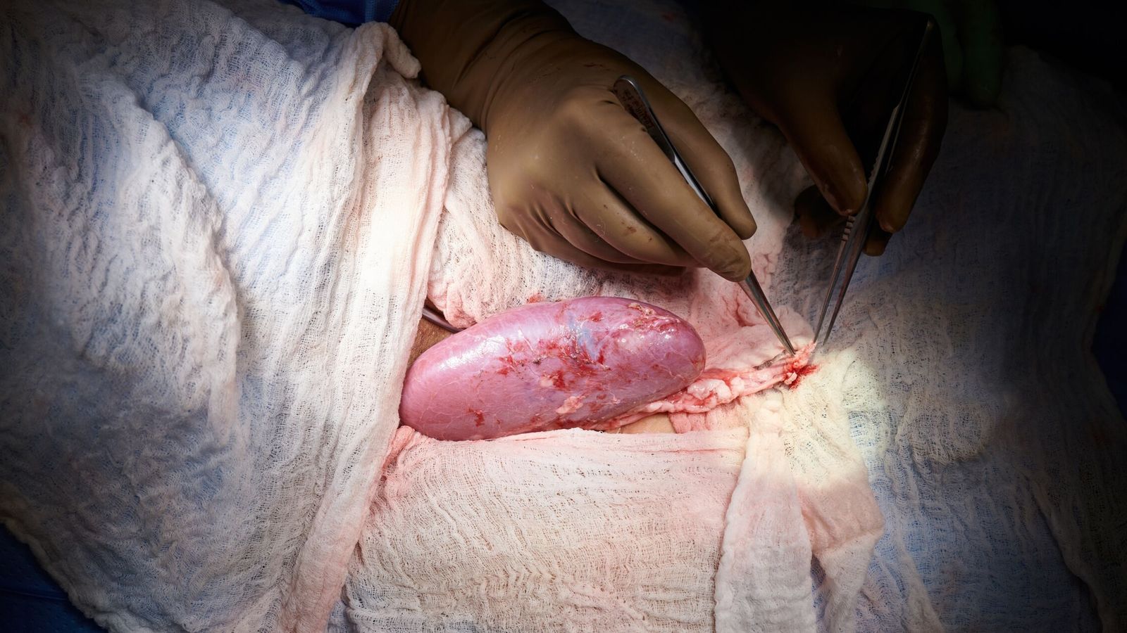 Imagen de archivo de un trasplante de riñón de cerdo no modificado en 2021. (EFE/NYU Langone Health/Joe Carrotta)