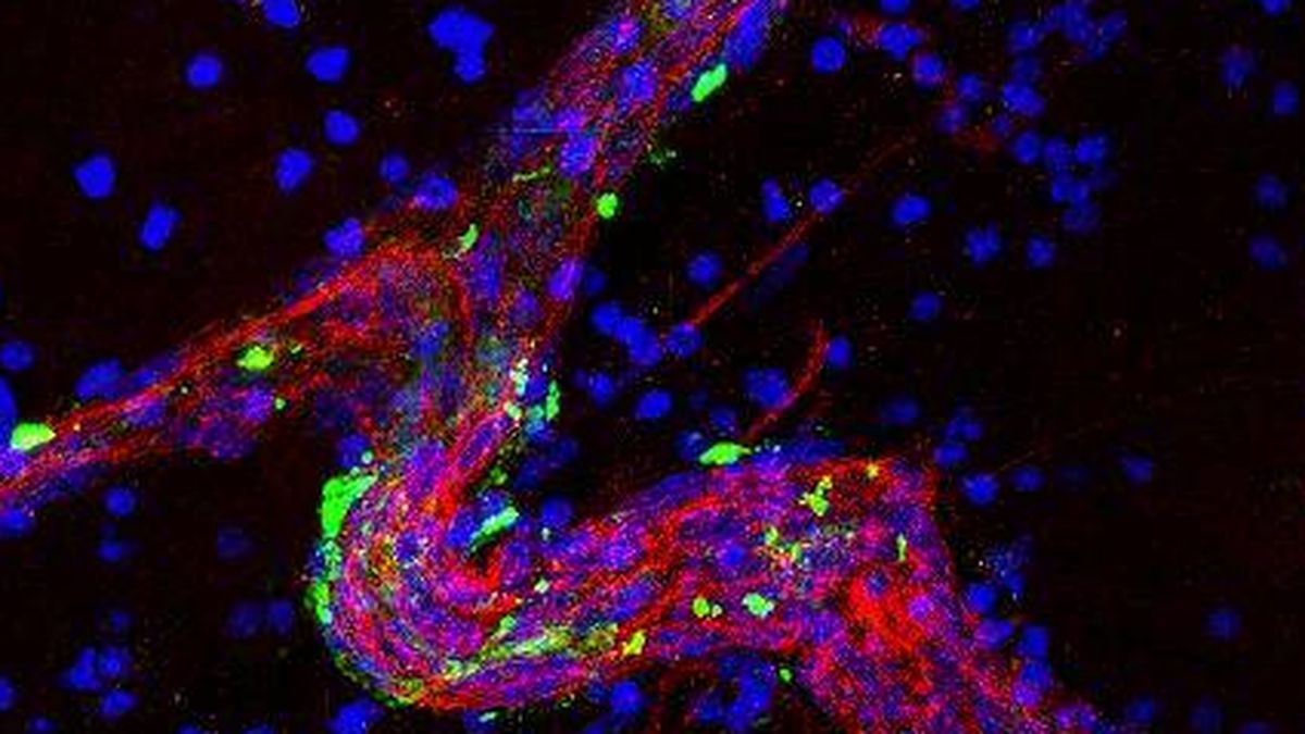 Hallan la proteína responsable de la metástasis cerebral del cáncer