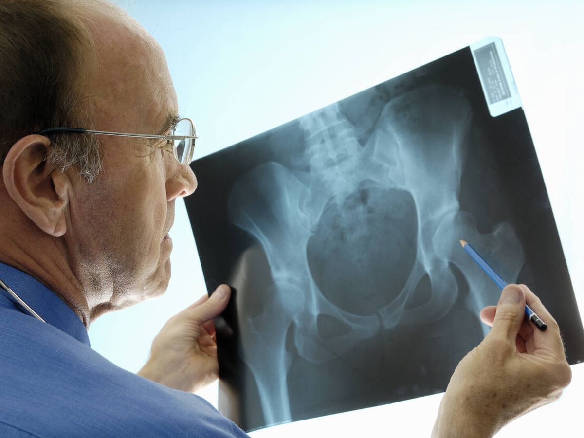 Foto: El 25% de las fracturas osteoporóticas se producen entre la población masculina. (iStock)