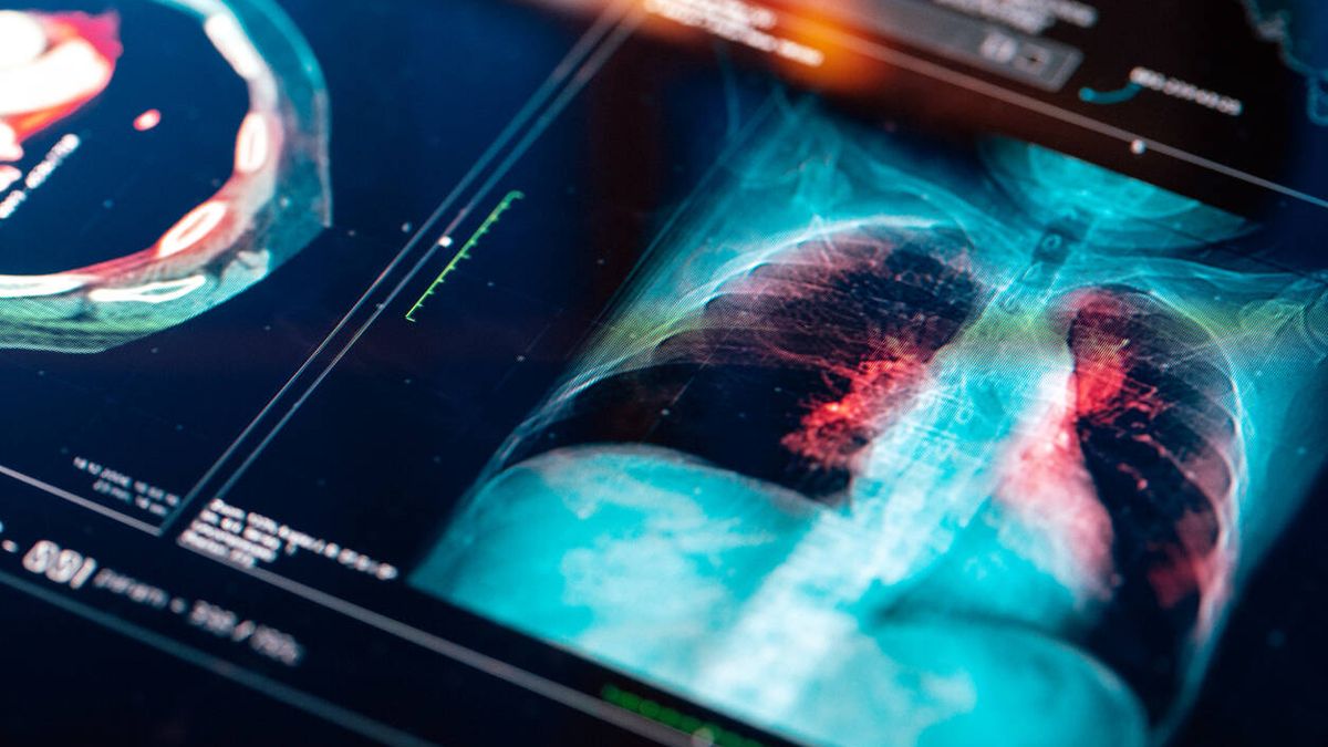 Un análisis de sangre predice quién tiene mayor riesgo de cáncer de pulmón