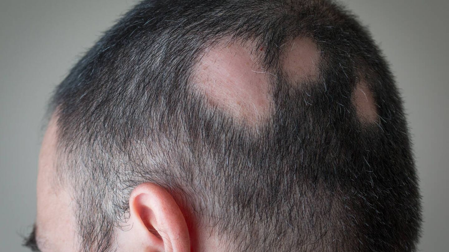 Alopecia areata. (iStock)