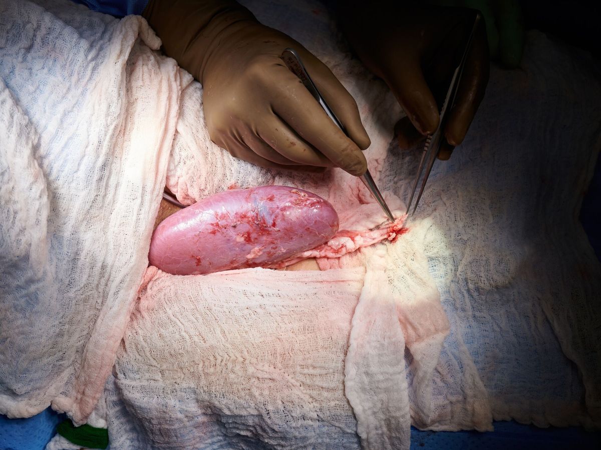 Foto: Trasplante de un riñón de cerdo a un humano en el hospital Langone Health, de Nueva York (Foto: EFE) consiguen trasplantar un riñón de cerdo a un humano en nueva york