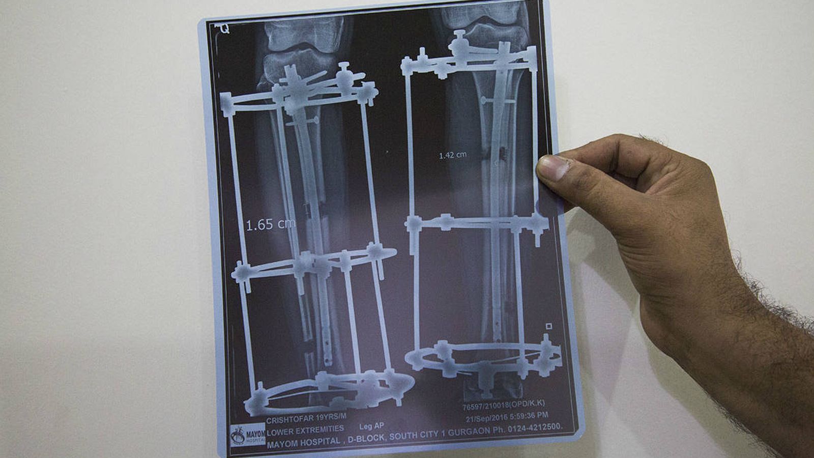 Foto: Radiografía de un paciente sometido a una operación de alargamiento de piernas en la India (E. del Estal)