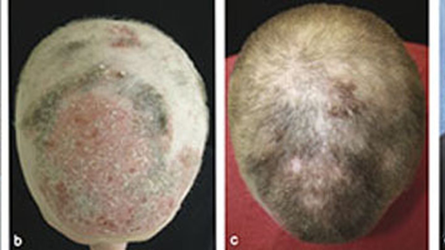 Paciente de 25 años con alopecia universalis y psoriasis a) antes del tratamiento con tofacitinib b) dos meses con terapia c) cinco meses con tratamiento, y d) ocho meses después. (Brett A. King et al.)