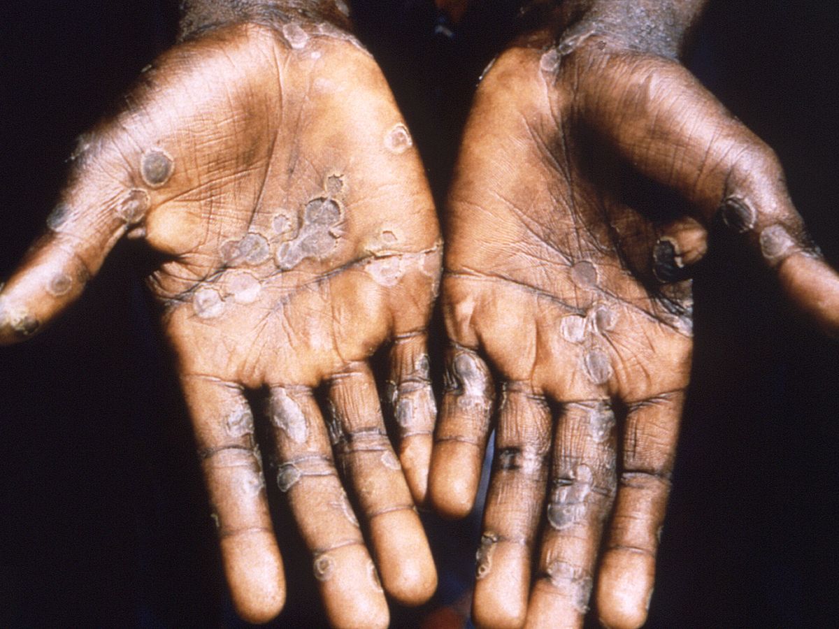 Foto: Imagen de las lesiones en la piel provocadas por la viruela del mono, durante un estudio llevado a cabo en la República Democrática del Congo. (EFE//Brian W.j. Mahy Center for Disease Control and Prevention)