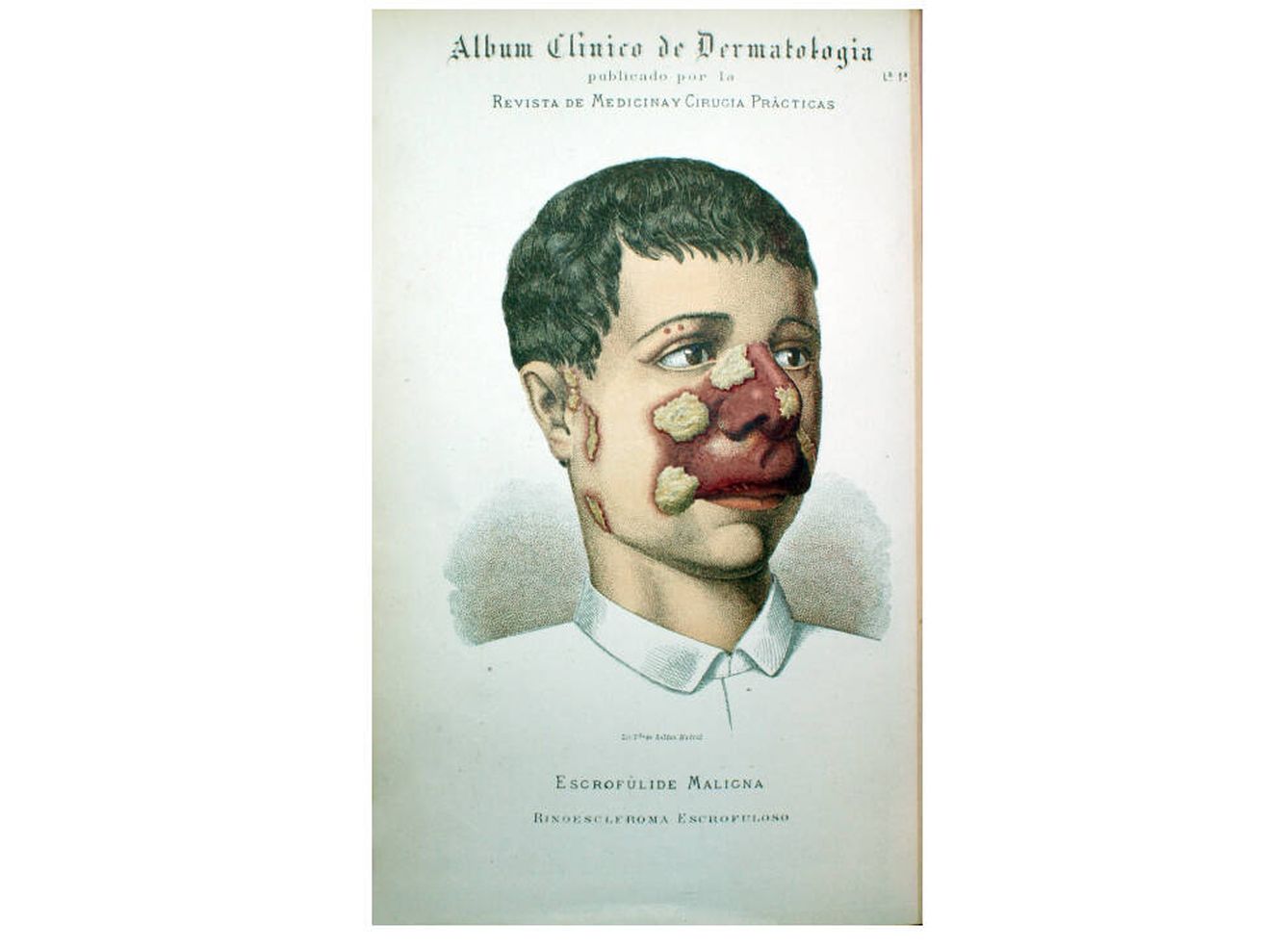 Otra lámina del 'Álbum Clínico de Dermatología' de Pérez Ortiz (1886). (Museo Olavide)