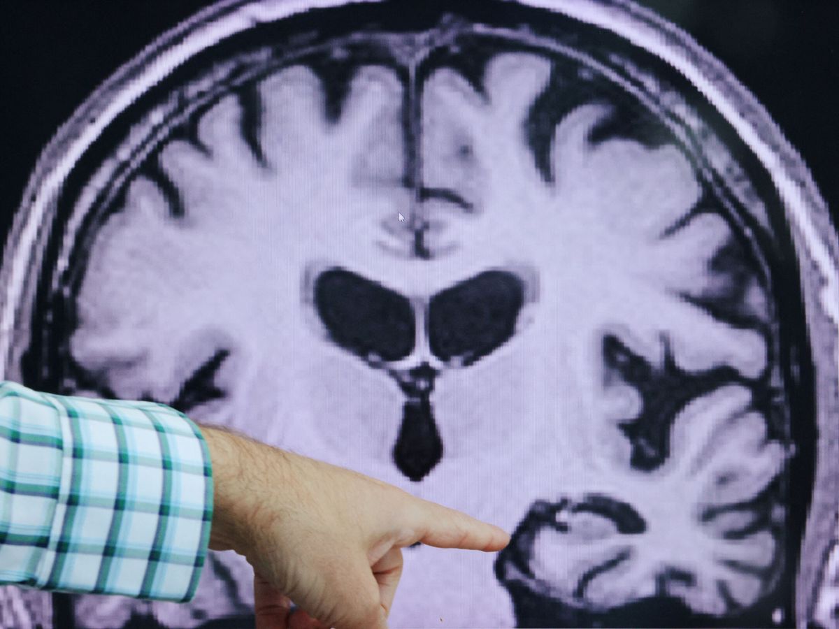Foto: Evidencias de alzhéimer en el cerebro. (Reuters/Brian Snyder)