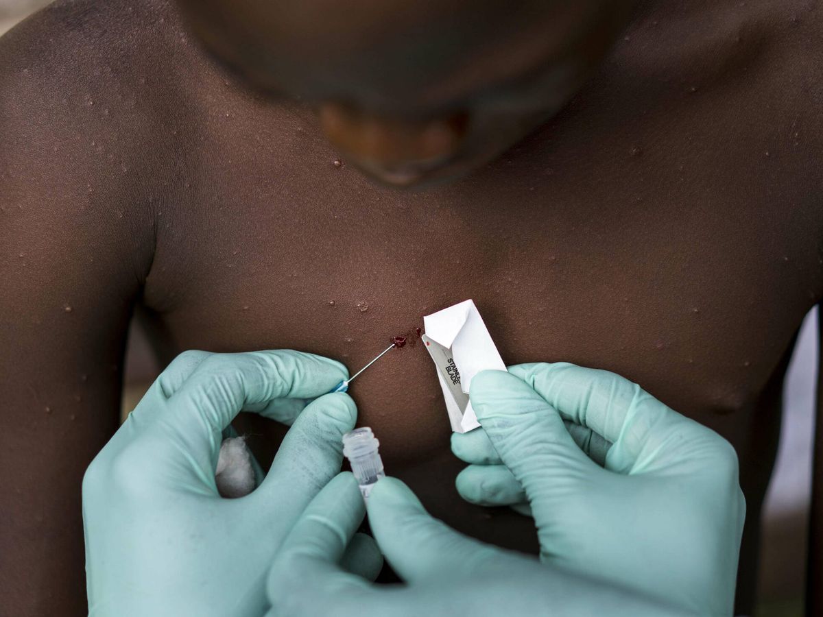 Foto: Un equipo de la República del Congo estudia el virus de la viruela del mono. (Gettt)