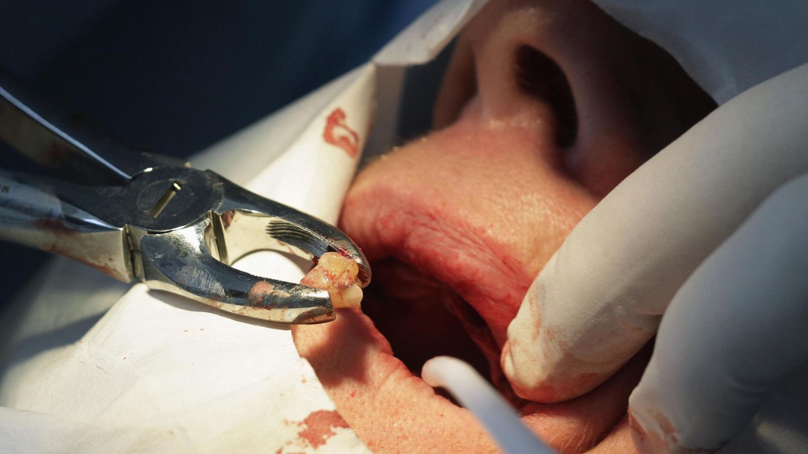 Foto: Foto de archivo de un dentista extrayendo un diente (Reuters)