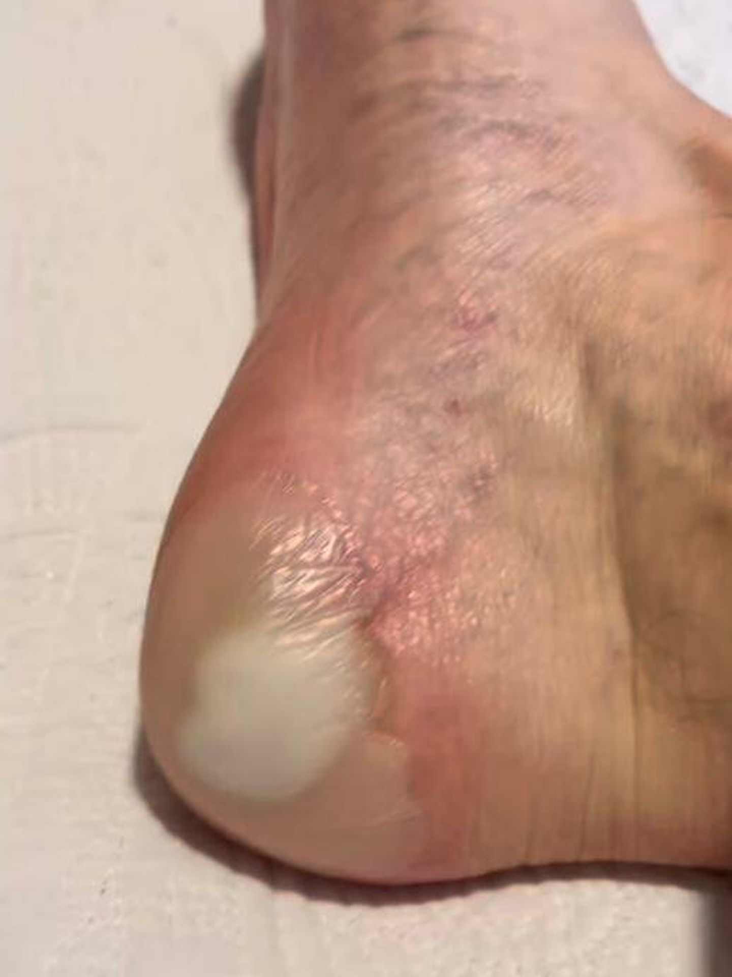 Detalle de las heridas de los pies de Iñigo Onieva. (Instagram/@ionieva)