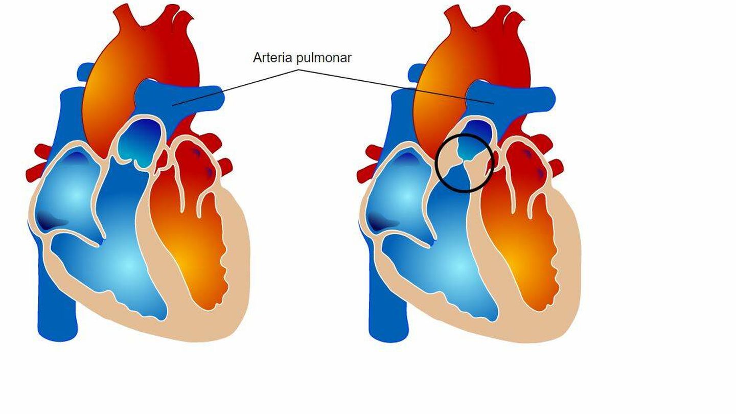 A la izquierda, un corazón normal; a la derecha, uno con la válvula pulmonar obstruida. (Wikimedia Commons)