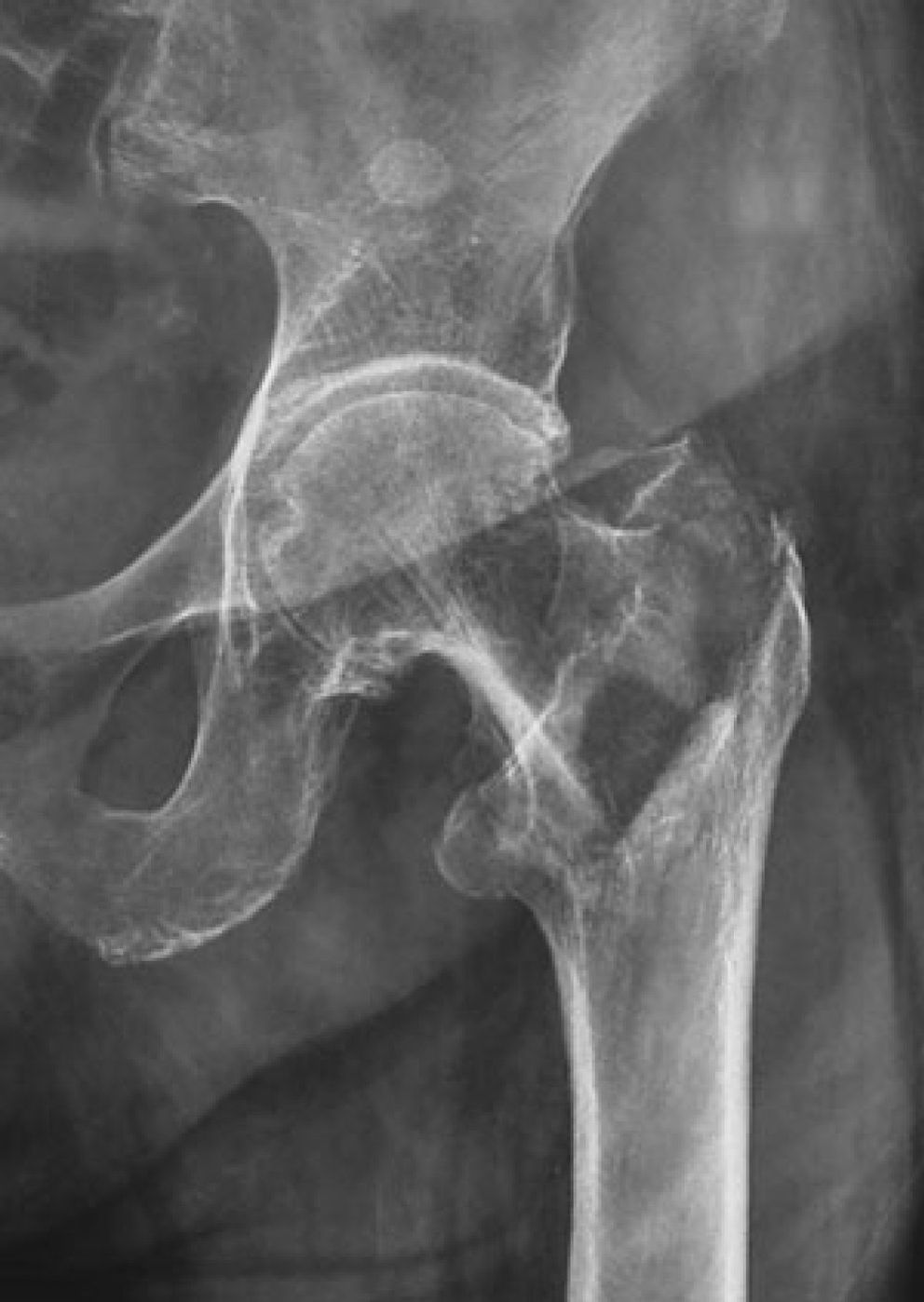 Foto: A partir de los 50 años, el 40% de las mujeres y el 13% de los hombres tienen riesgo de padecer una fractura osteoporótica