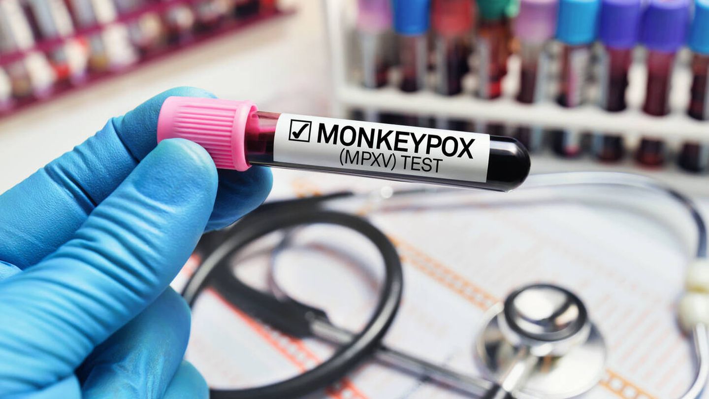 Médico con una muestra de sangre en un tubo diagnosticado con la enfermedad de la viruela del mono (MPXV). (iStock)