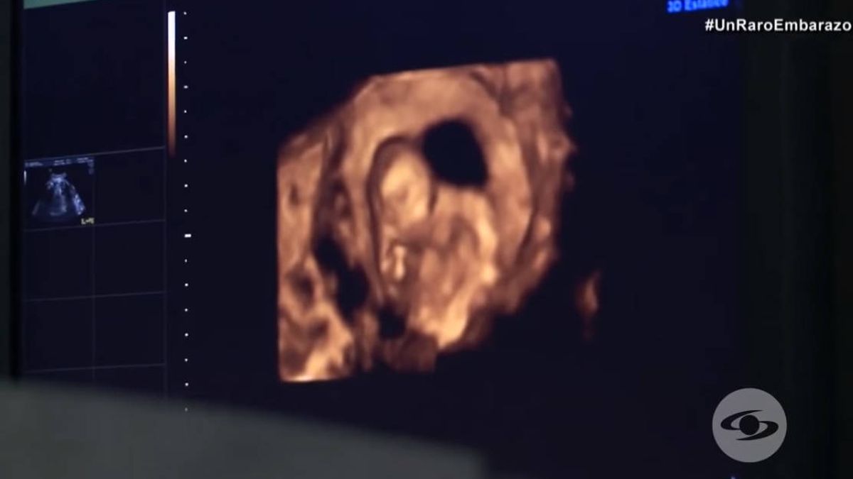 Una bebé nace en Colombia con el feto de su hermano gemelo en su interior