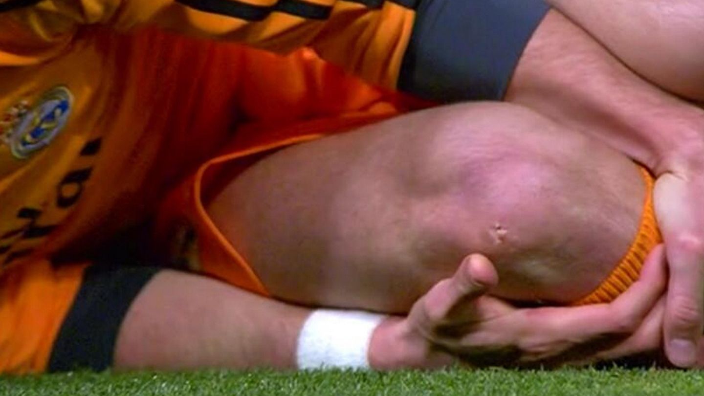 La marca de los tacos en la rodilla de Bale (Twitter: @David_Guti).