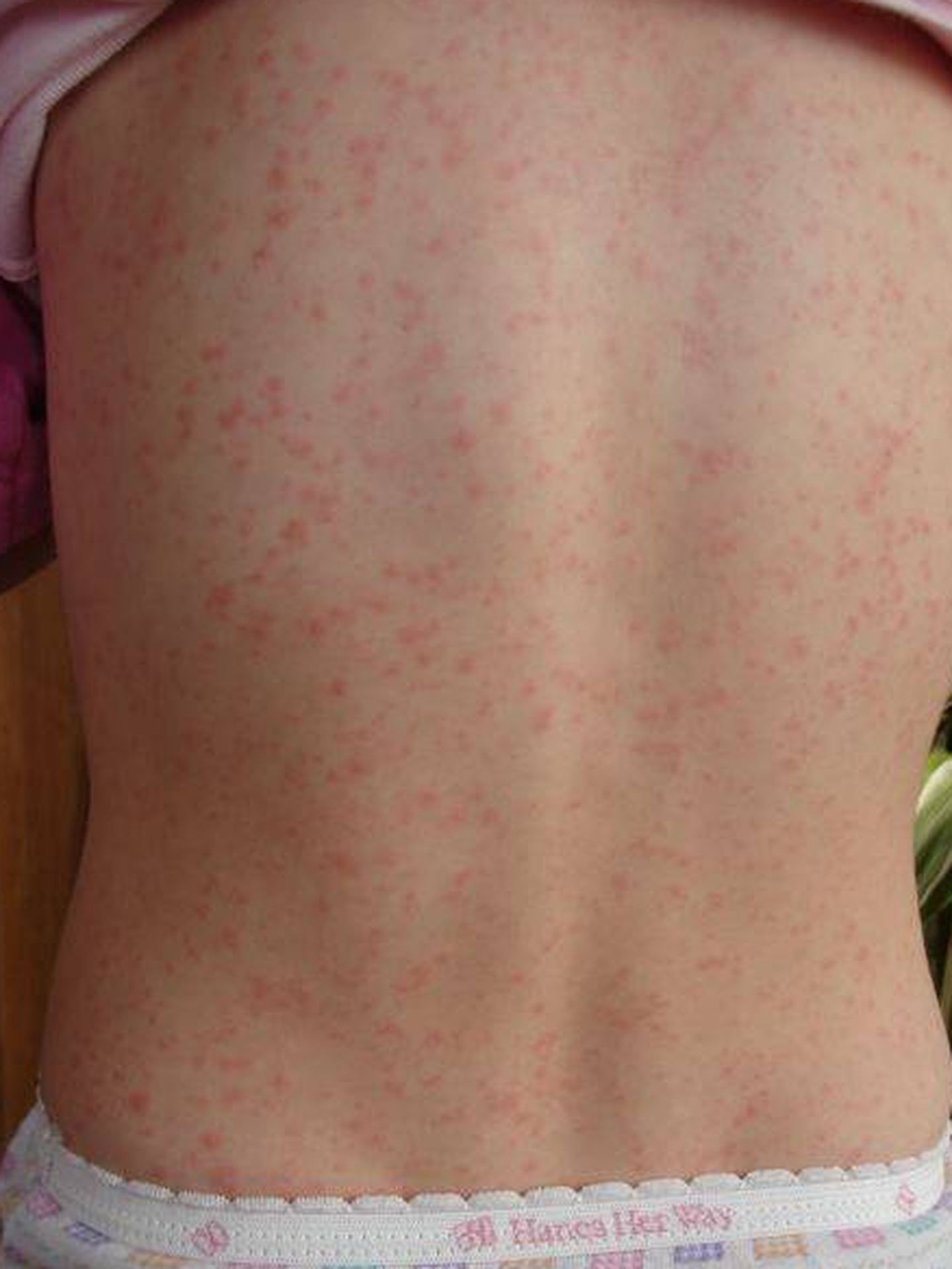 Eritemas provocadas en la piel por la escarlatina. Foto: Wikipedia