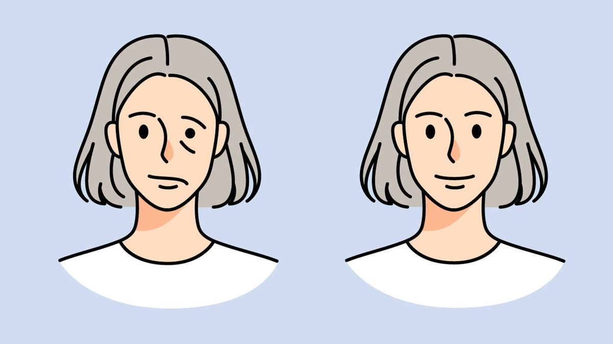 Todo lo que necesitas saber sobre la parálisis facial