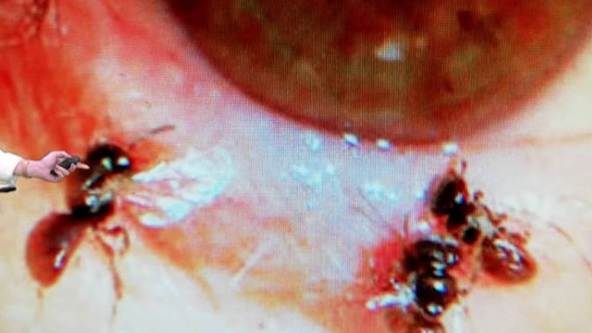 Encuentran cuatro abejas vivas en el interior del ojo de una mujer de 29 años