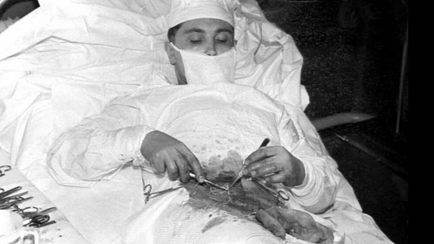 Leonid Rogozov, realizándose una apendicectomía en la Antártida (Archivo)
