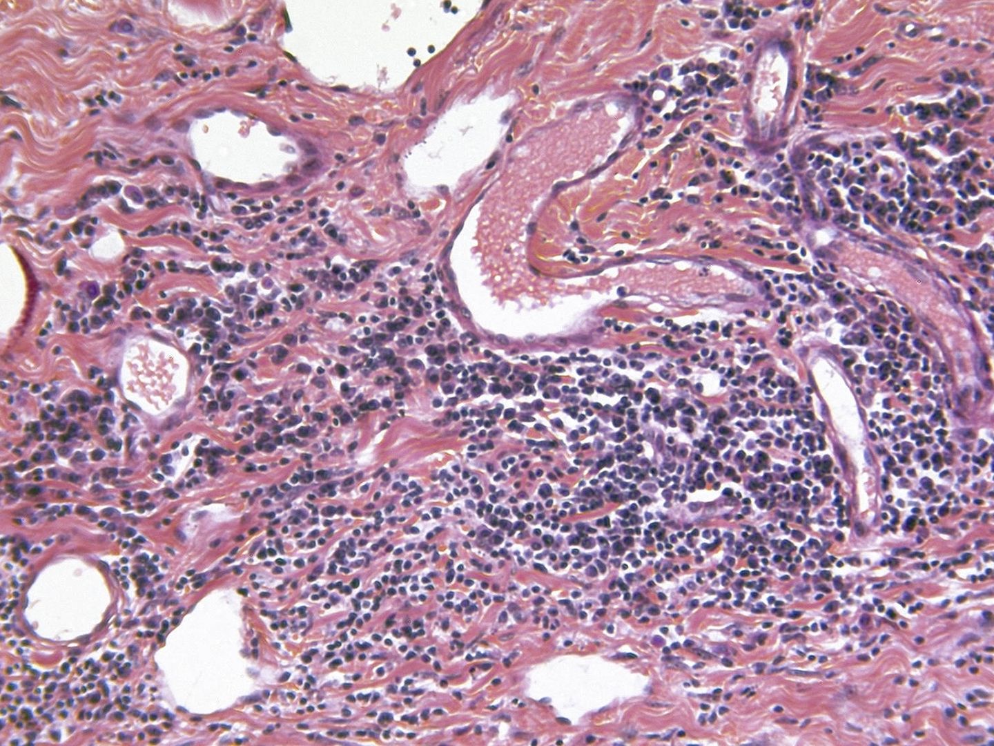 Células epiteliales escamosas en fase metastásicas. (iStock)