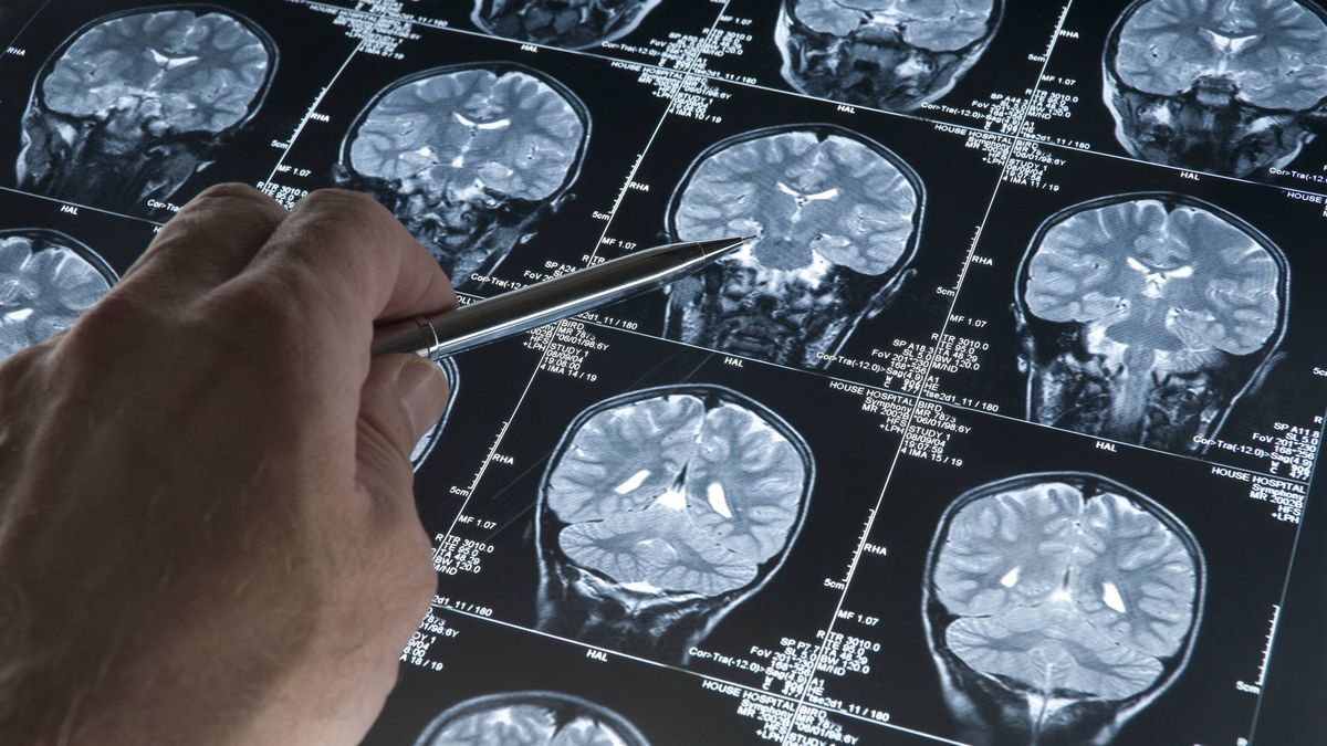La sorprendente razón detrás del alzheimer: un estudio lo cambia todo