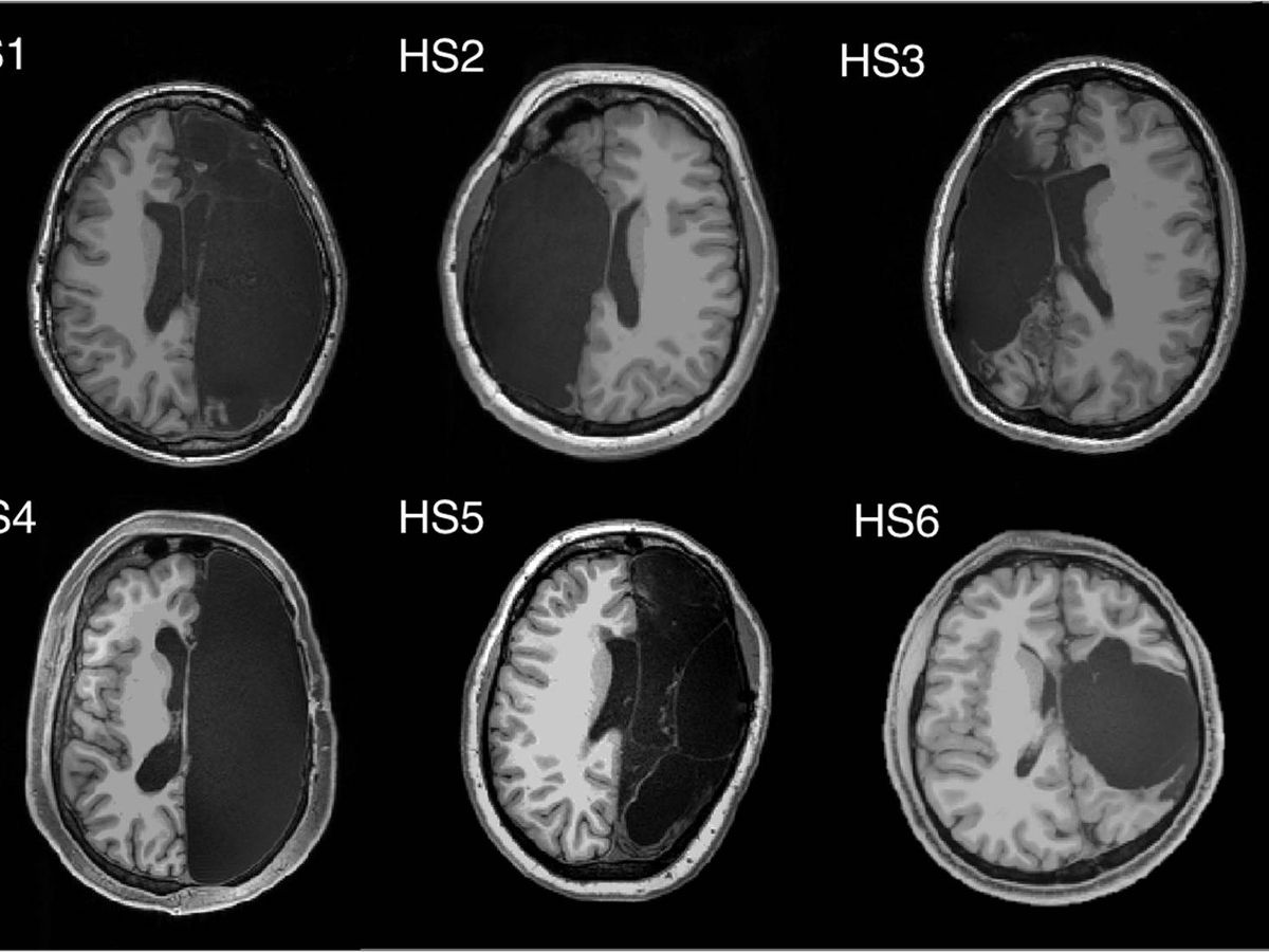Foto: Fotos de resonancias de cerebros sin un hemisferio. Foto: Caltech