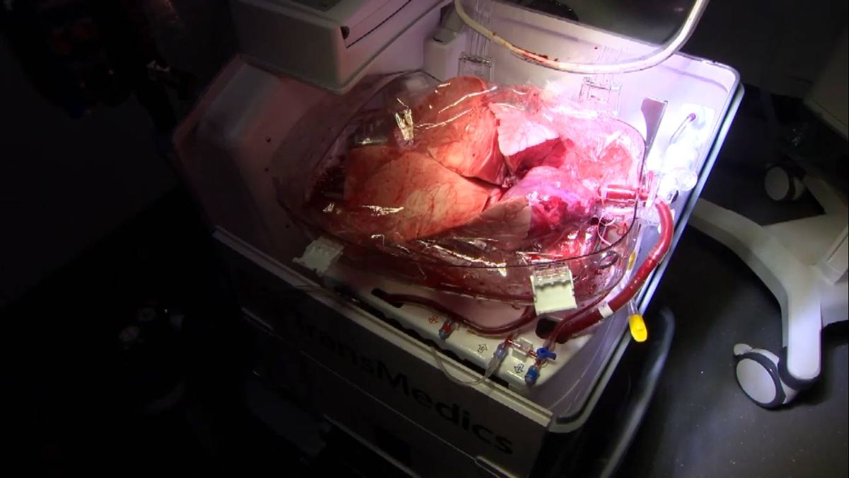 Desarrollan una máquina que revitaliza órganos para el trasplante