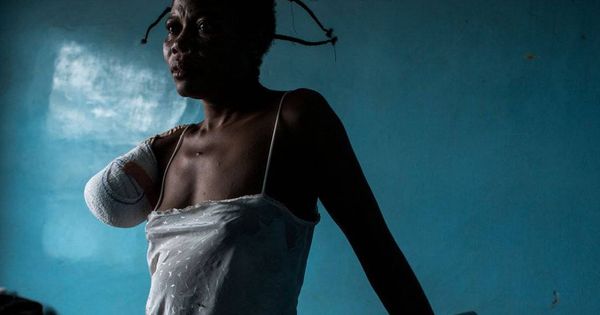 Foto: Una mujer víctima de la violencia de Kasai, refugiada en un hospital de Angola. (Fuente: FIDH)