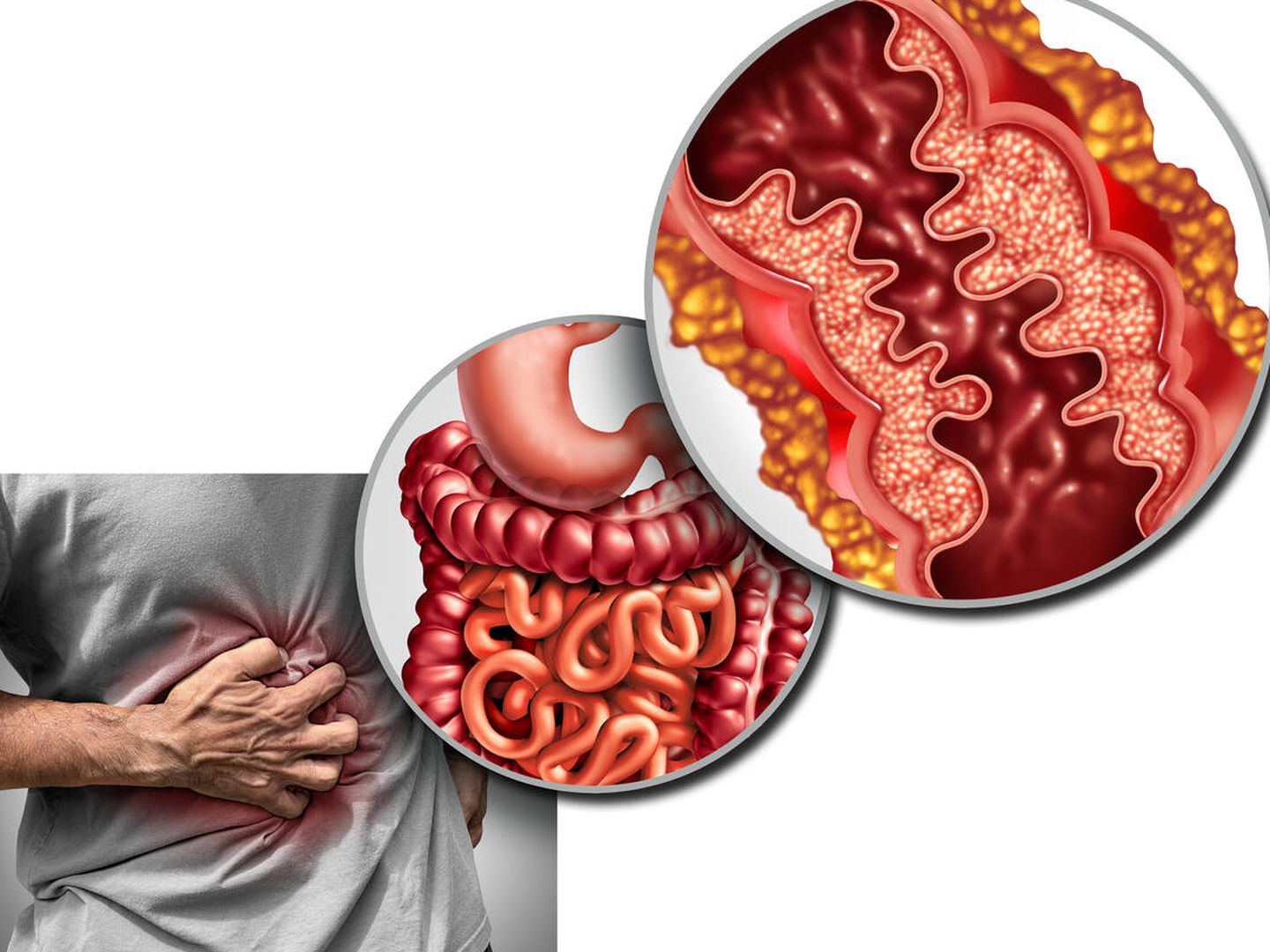 El dolor abdominal es un síntoma de inflamación intestinal. (iStock)