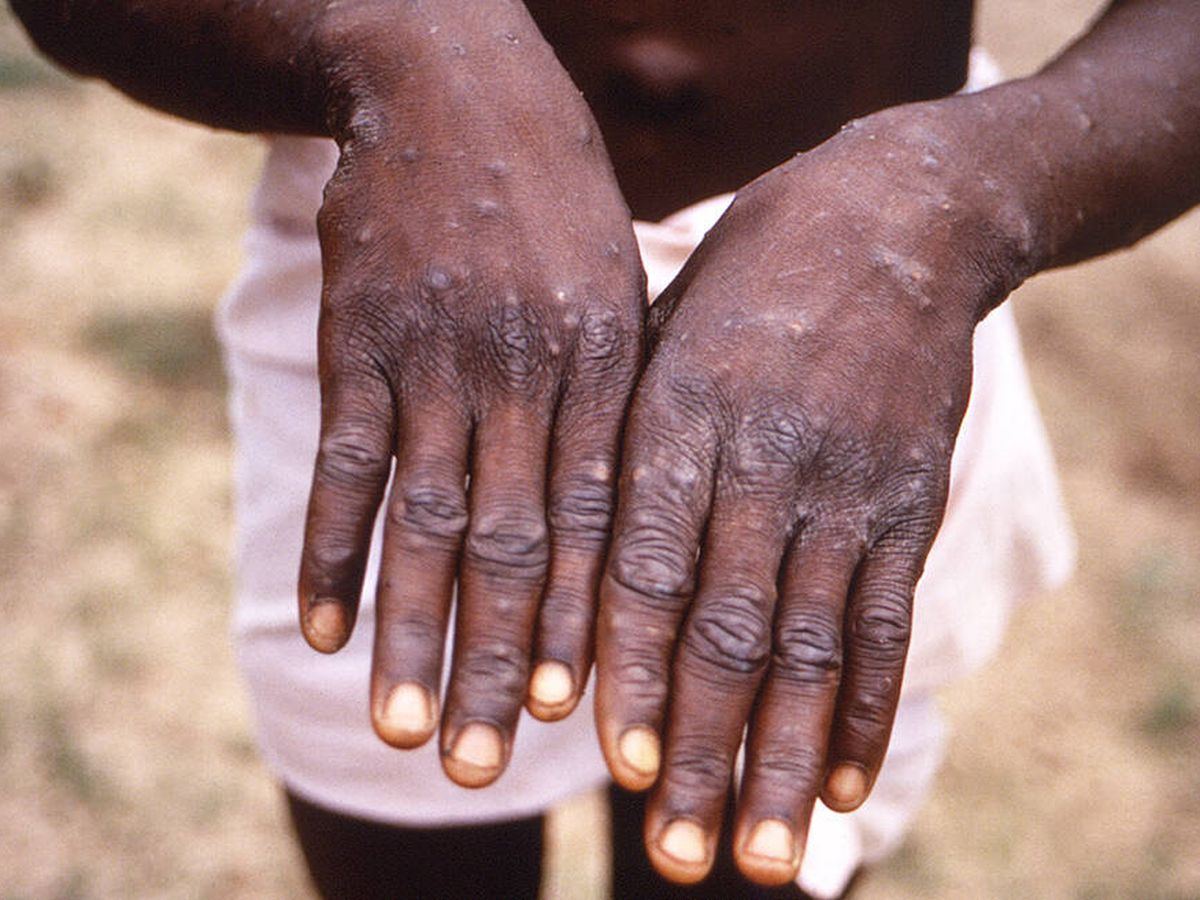Foto: Un niño muestra sus manos tras contraer la viruela del mono.(CDC)