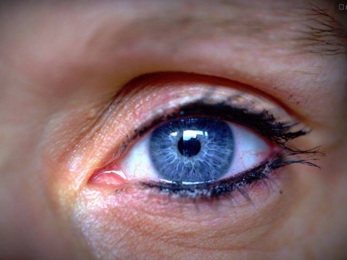 Foto: Infección en un ojo