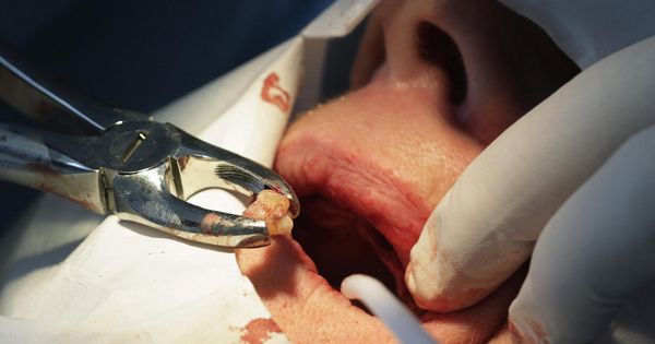 Foto: Foto de archivo de un dentista extrayendo un diente (Reuters)