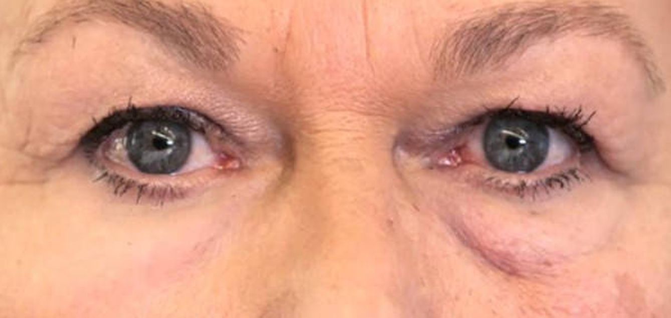 En pruebas con humanos se ha visto que reduce las bolsas de los ojos y también mejora la hidratación de la piel. / Olivo Labs, LLC