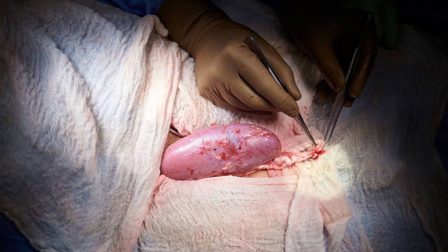 Trasplante del riñón de un cerdo genéticamente modificado a un cuerpo humano en NY. (EFE / NYU Langone Health / Joe Carrotta) 