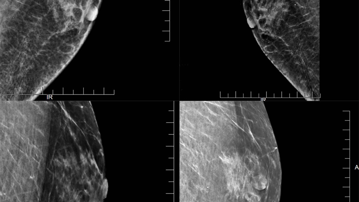 Cuando el cáncer de mama les afecta a ellos: síntomas y diagnóstico de un tumor 'invisible'