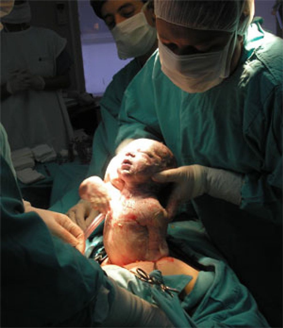 Una cesárea 'natural' imita el parto vaginal