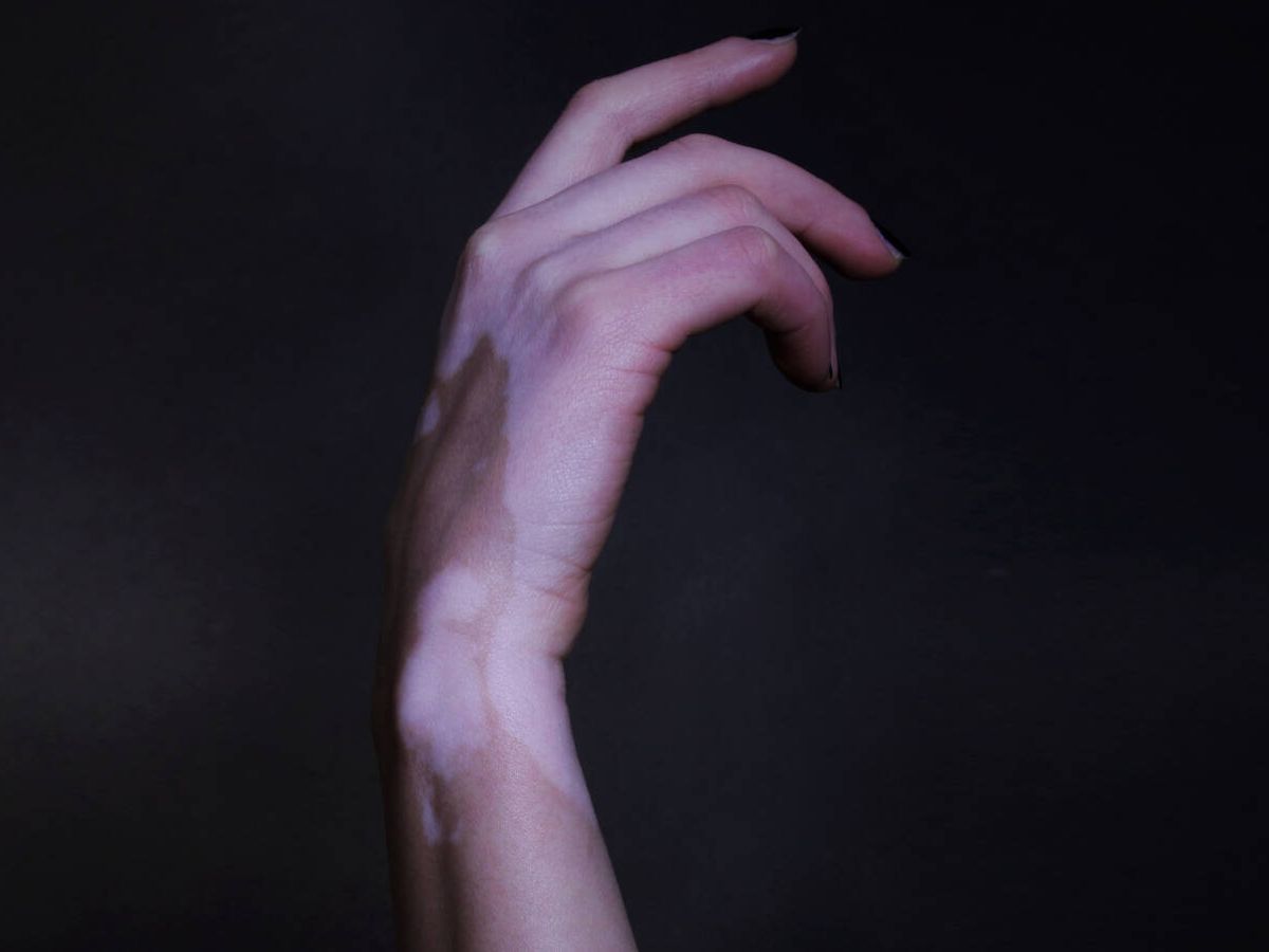 Foto: Caso de vitíligo en mano y antebrazo. (Unsplash/Hanen Boubahri)