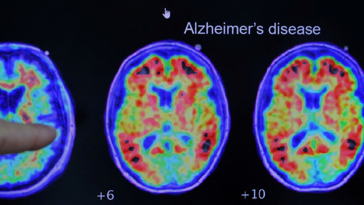 Investigadores consiguen revertir algunos síntomas de deterioro cognitivo del Alzheimer en ratones