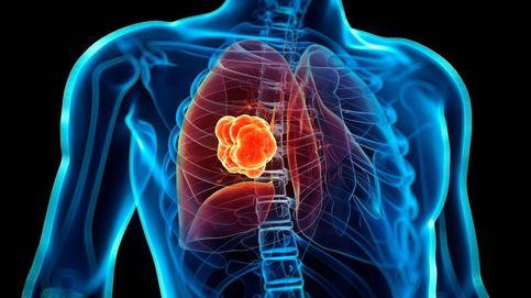¿Qué posibilidades hay de heredar un cáncer de pulmón?