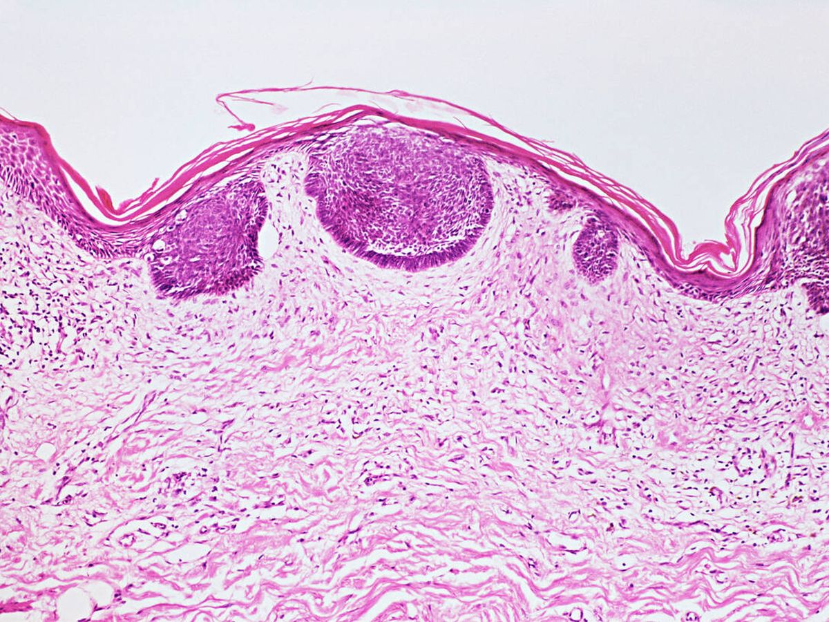 Foto: Cáncer de piel visto a través de un microscopio. (iStock)