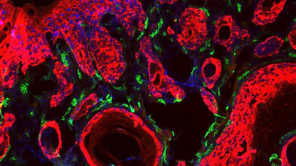 Científicos españoles desarrollan una técnica para matar las células del cáncer por calor