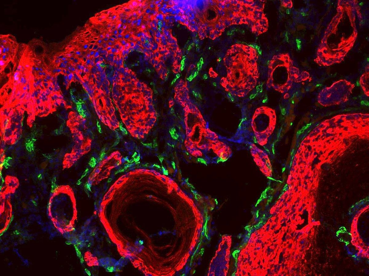 Foto: Células tumorales (rojo) y los vasos sanguíneos que le proporcionan nutrientes (en verde). Foto: EFE